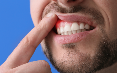 Gingiile care sângerează frecvent, respirația urât mirositoare sau o peliculă albicioasă pe limbă pot fi semne care ascund mai mult decât simple probleme ale cavității bucale