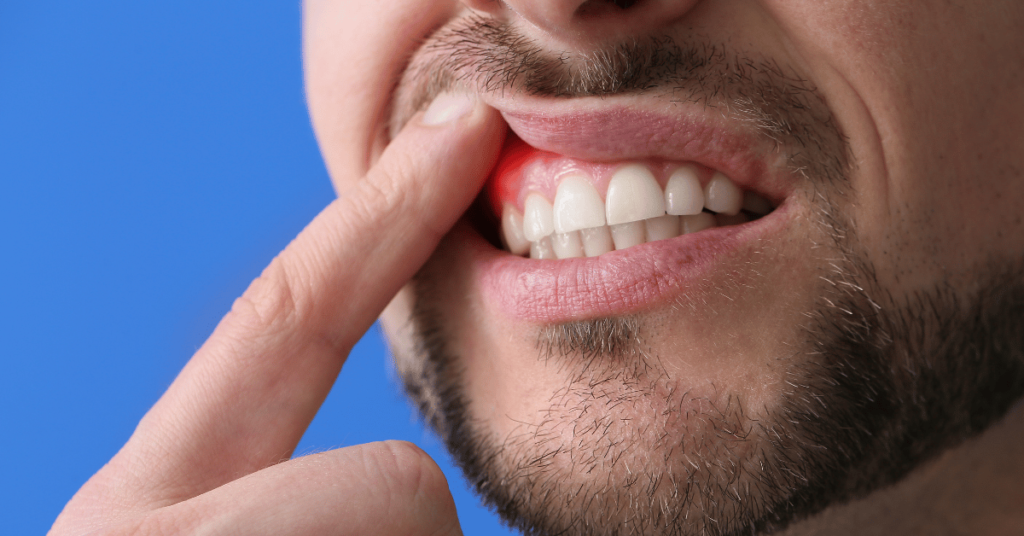 Gingiile care sângerează frecvent, respirația urât mirositoare sau o peliculă albicioasă pe limbă pot fi semne care ascund mai mult decât simple probleme ale cavității bucale