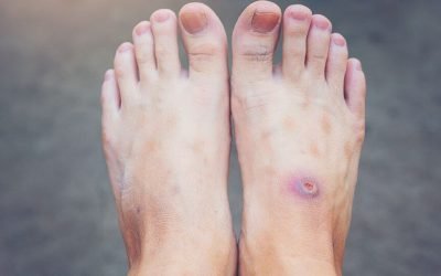 Picioarele uscate, crăpate sau îngroșate pot ascunde mai mult decât o problemă estetică: pot fi un semnal de alarmă pentru afecțiuni grave, inclusiv diabetul