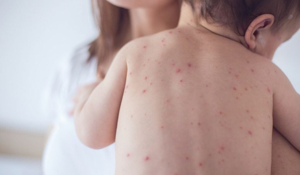 Rujeola face ravagii în România, numărul cazurilor raportate ajungând la peste 35.700, cu 30 de decese înregistrate, în timp ce specialiștii atrag atenția asupra pericolului iminent reprezentat de această boală extrem de contagioasă