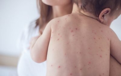Rujeola face ravagii în România, numărul cazurilor raportate ajungând la peste 35.700, cu 30 de decese înregistrate, în timp ce specialiștii atrag atenția asupra pericolului iminent reprezentat de această boală extrem de contagioasă