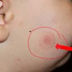 Ciuhodaru, avertisment crucial: sezonul căpușelor aduce urgențe. Când mergi la medic