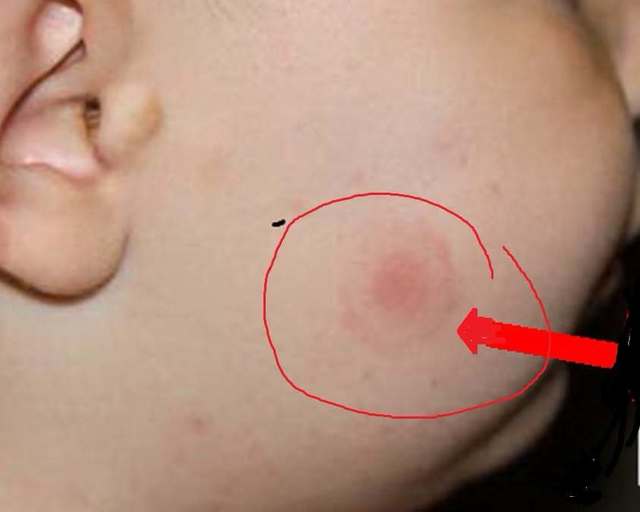 Ciuhodaru, avertisment crucial: sezonul căpușelor aduce urgențe. Când mergi la medic