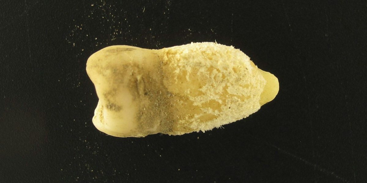 Bacterie de scarlatină, găsită într-o mumie: Misterele Americii Precolumbiene dezvăluite