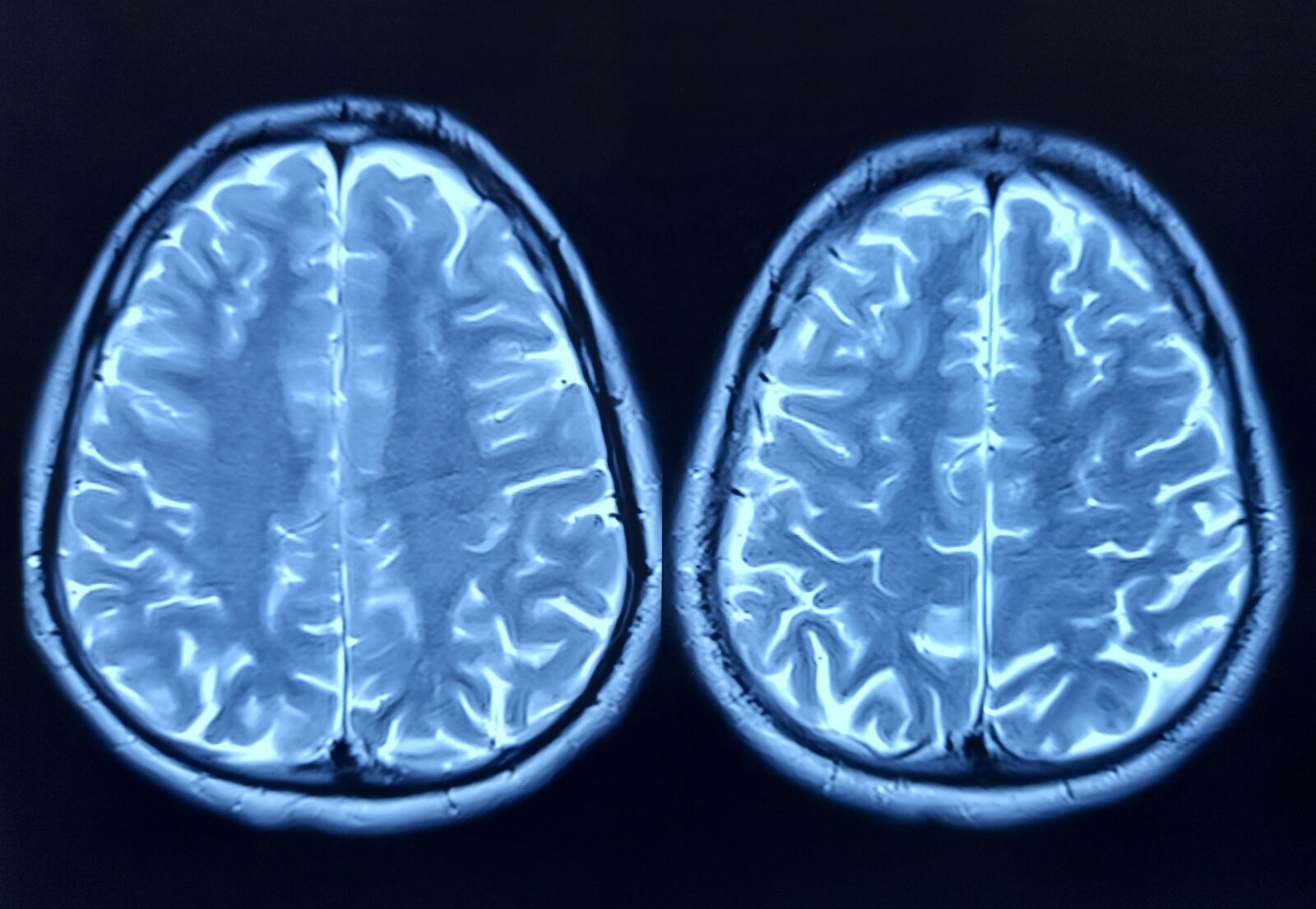 O proteină care pare să pună în pericol funcționarea creierului odată cu îmbătrânirea Cercetătorii au identificat o proteină numită FTL1, care ar putea fi un factor cheie în declinul cognitiv asociat cu vârsta