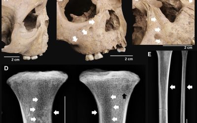 Descoperire surprinzătoare despre bolile antice ale dinților copilăriei Cercetătorii au identificat pentru prima dată în Vietnam semne clare ale unei boli bacteriene grave, cea a treponematozei, în schelete de copii din Epoca de Piatră datând acum aproximativ 4.000 de ani