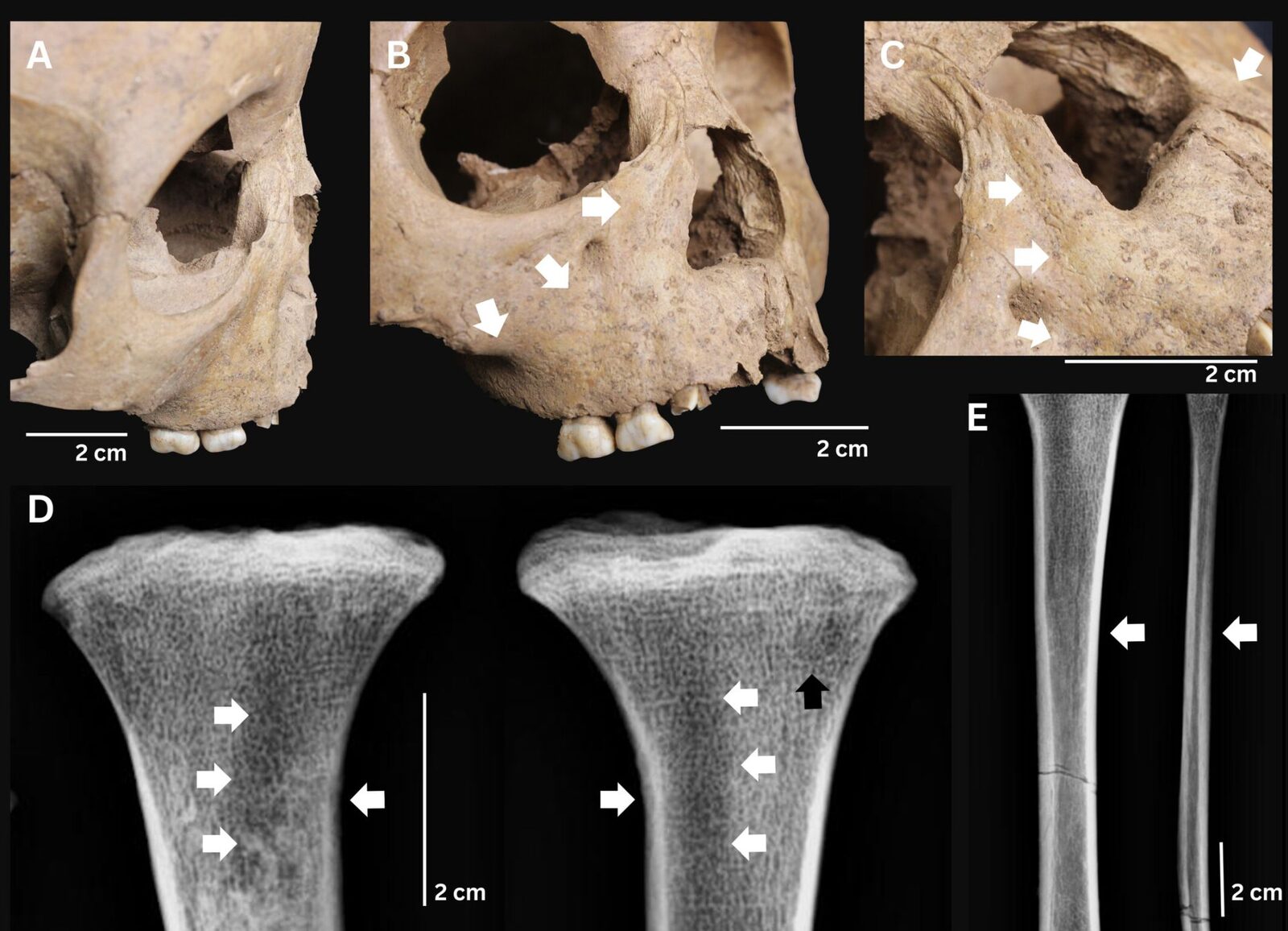 Descoperire surprinzătoare despre bolile antice ale dinților copilăriei Cercetătorii au identificat pentru prima dată în Vietnam semne clare ale unei boli bacteriene grave, cea a treponematozei, în schelete de copii din Epoca de Piatră datând acum aproximativ 4.000 de ani
