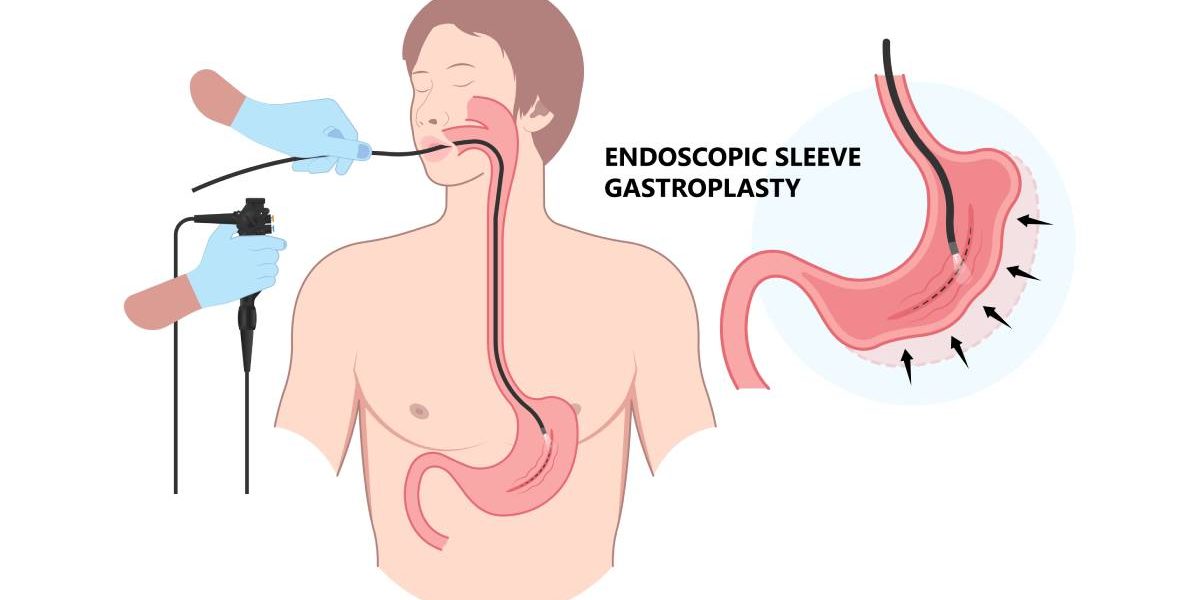 Micșorarea de stomac fără bisturiu: Noua metodă endoscopică de slăbire