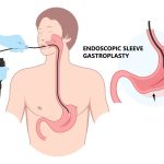 Micșorarea de stomac fără bisturiu: Noua metodă endoscopică de slăbire