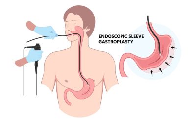 Micșorarea de stomac fără bisturiu: Noua metodă endoscopică de slăbire