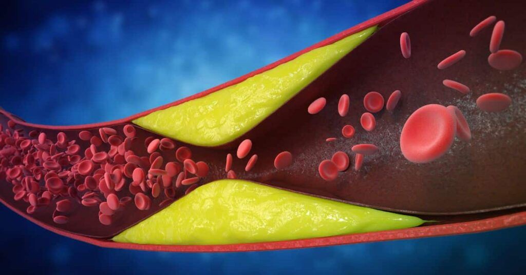 7 semne subtile ale arterelor blocate: Cardiologii avertizează, mulți le ignoră