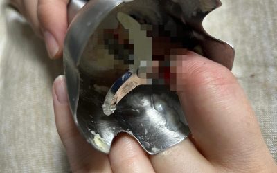 Două ieșence, victime ale unor accidente casnice grave