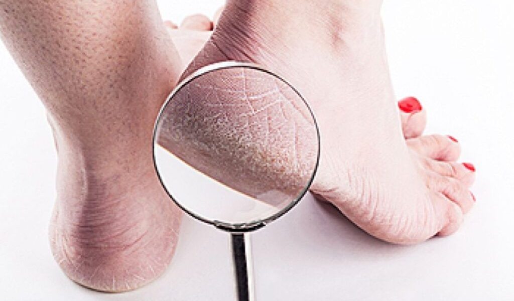 Culoarea călcâielor poate indica o boală de ficat: Avertisment de la un medic