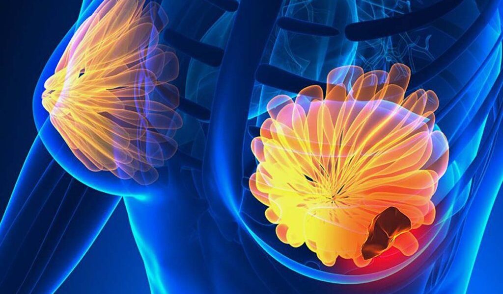 Uite CE semne NU trebuie ignorate: TOP 5 simptome ale cancerului de sân