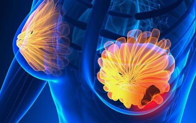 Uite CE semne NU trebuie ignorate: TOP 5 simptome ale cancerului de sân