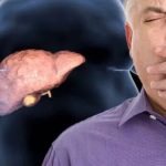 Tratament revoluționar pentru ficatul gras: dietă neschimbată, rezultate uimitoare!