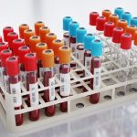 Analiză SÂNGELUI, mai precisă ca colesterolul, depistează riscul de infarct și AVC