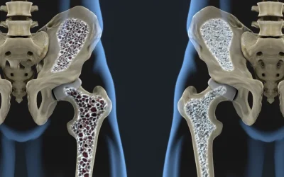 O nouă speranță pentru pacienții cu osteoporoză: cercetătorii germani anunță o descoperire majoră O echipă de cercetători din Germania a făcut o descoperire promițătoare care ar putea revoluționa tratamentul osteoporozei, o afecțiune caracterizată prin subțierea oaselor și creșterea riscului de fracturi