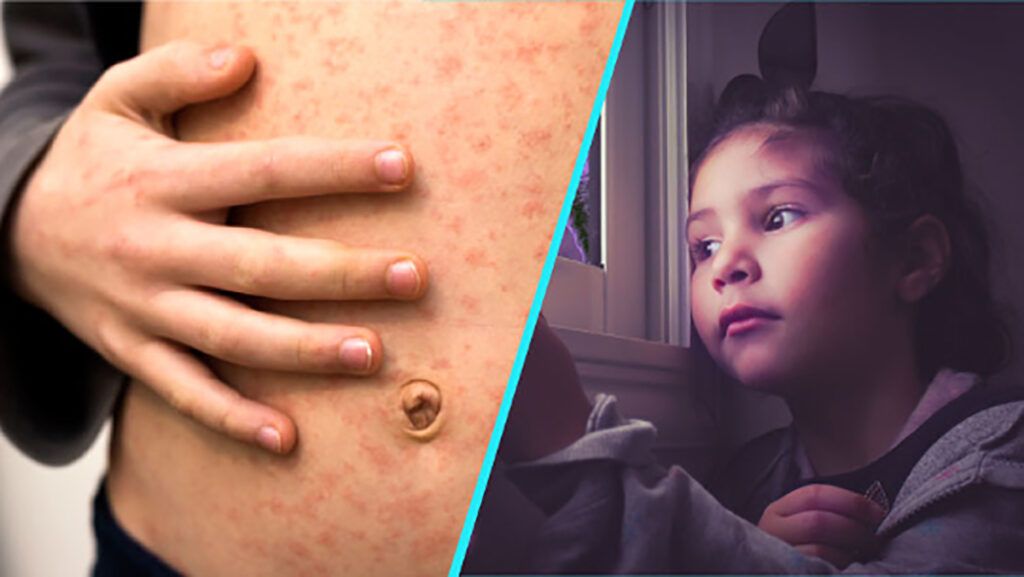 Rujeolă, gripă, vaccinare: Dr. Alexiu, despre drama copiilor din România