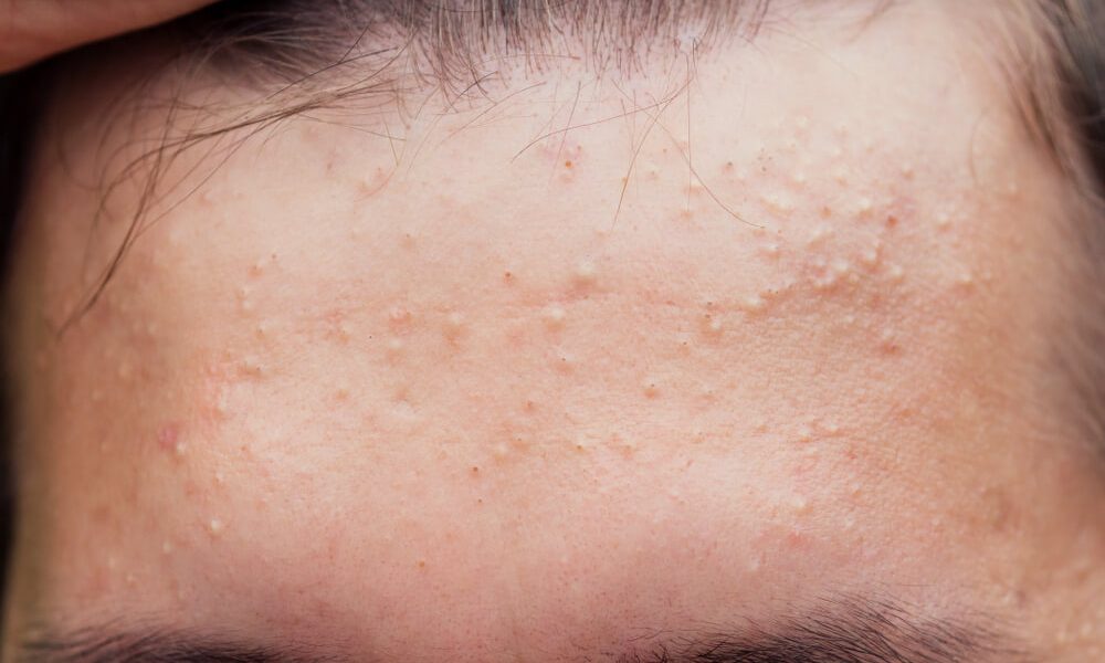 Acidul salicilic, un aliat de nădejde în lupta cu acneea, promite o soluție eficientă pentru un ten impecabil