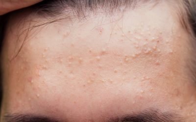 Acidul salicilic, un aliat de nădejde în lupta cu acneea, promite o soluție eficientă pentru un ten impecabil