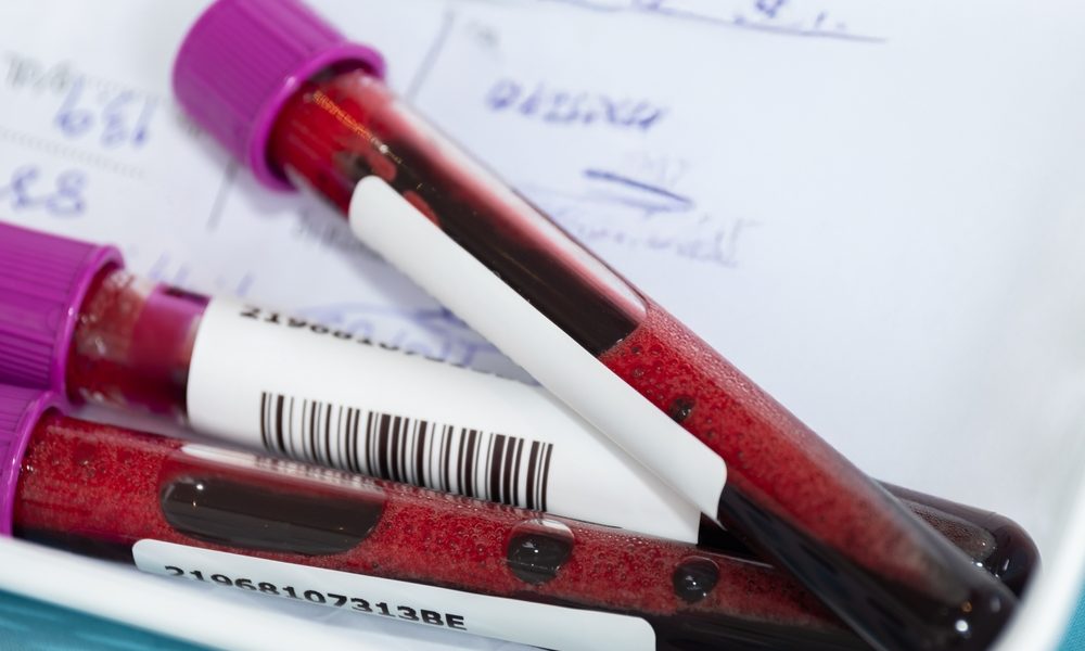 Ce analize indică afectarea rinichilor de diabet