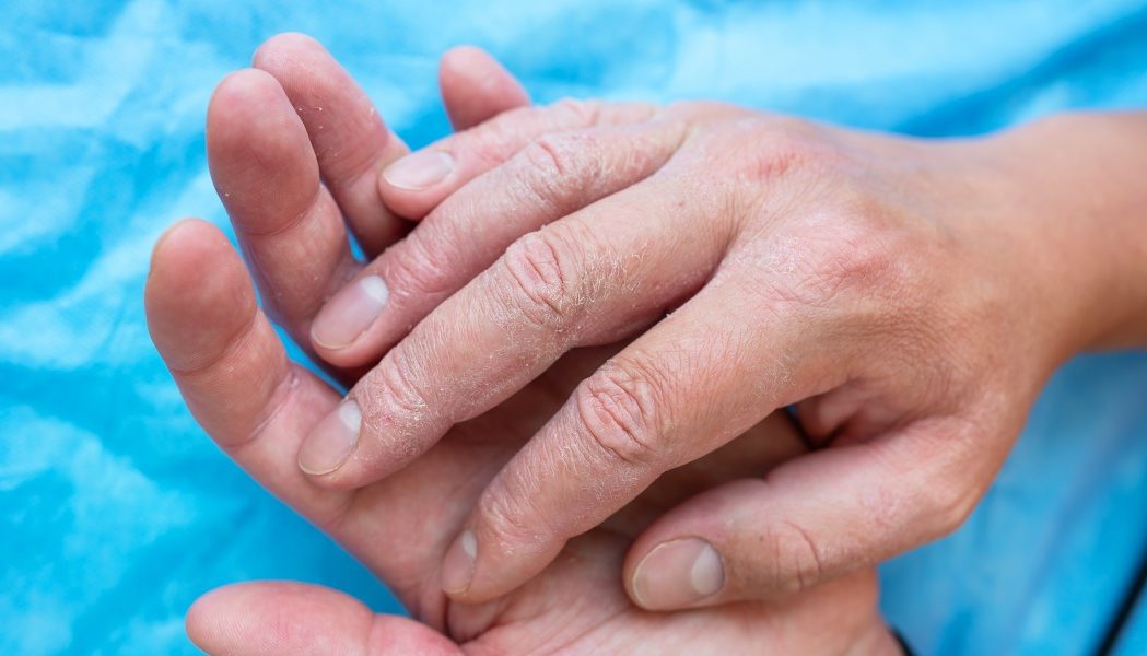 Un semn subtil pe degete, avertisment pentru boli pulmonare grave