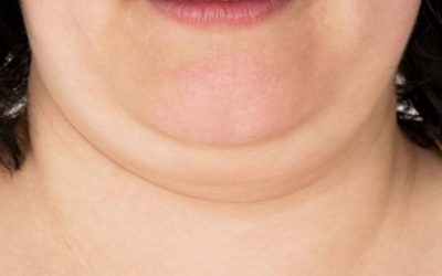 Vitamina-minune: Scapă de gușă și bărbie dublă în doar câteva săptămâni!