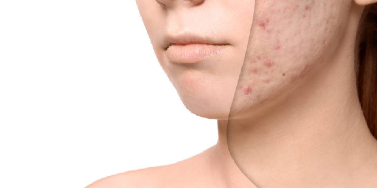 De ce apar petele pigmentare vara? Remedii naturale pentru un ten uniform