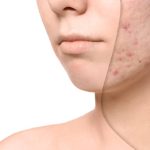 De ce apar petele pigmentare vara? Remedii naturale pentru un ten uniform