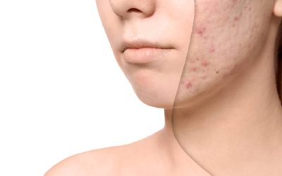 De ce apar petele pigmentare vara? Remedii naturale pentru un ten uniform
