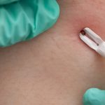 Alpha-Gal: Boala mortală declanșată de căpușă. Medici explicați