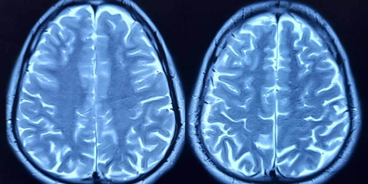 Minune medicală: Descoperit „organ imunitar” ascuns în craniu