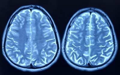 Minune medicală: Descoperit „organ imunitar” ascuns în craniu