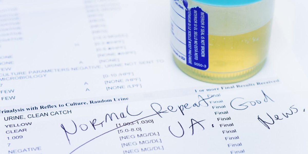 Test urină: depistează 9 din 10 cancere vezică