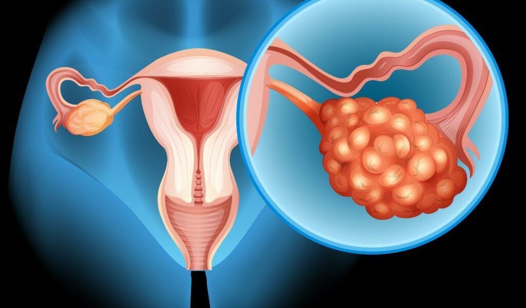 Prevenire cancer ovarian: intervenție minute